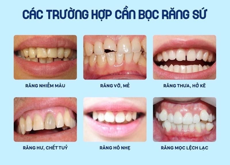 Bọc răng sứ thẩm mỹ