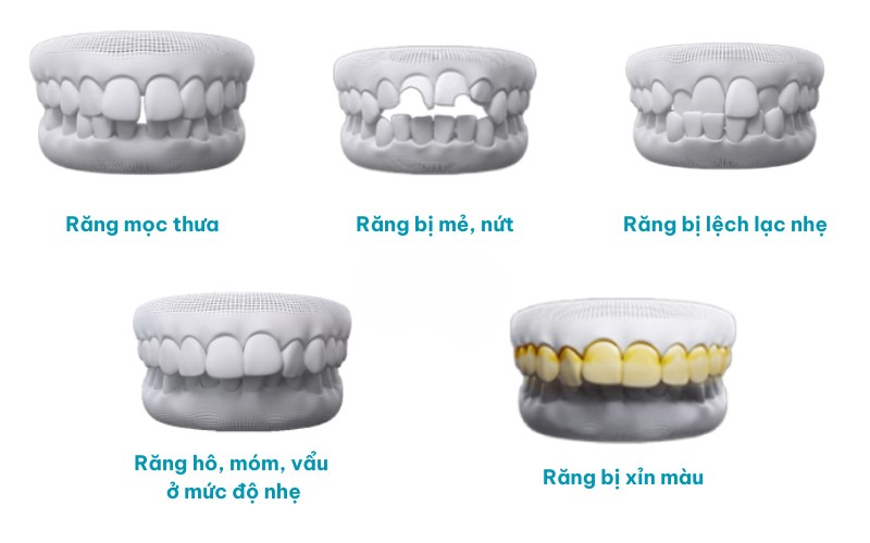 Dán sứ veneer thẩm mỹ