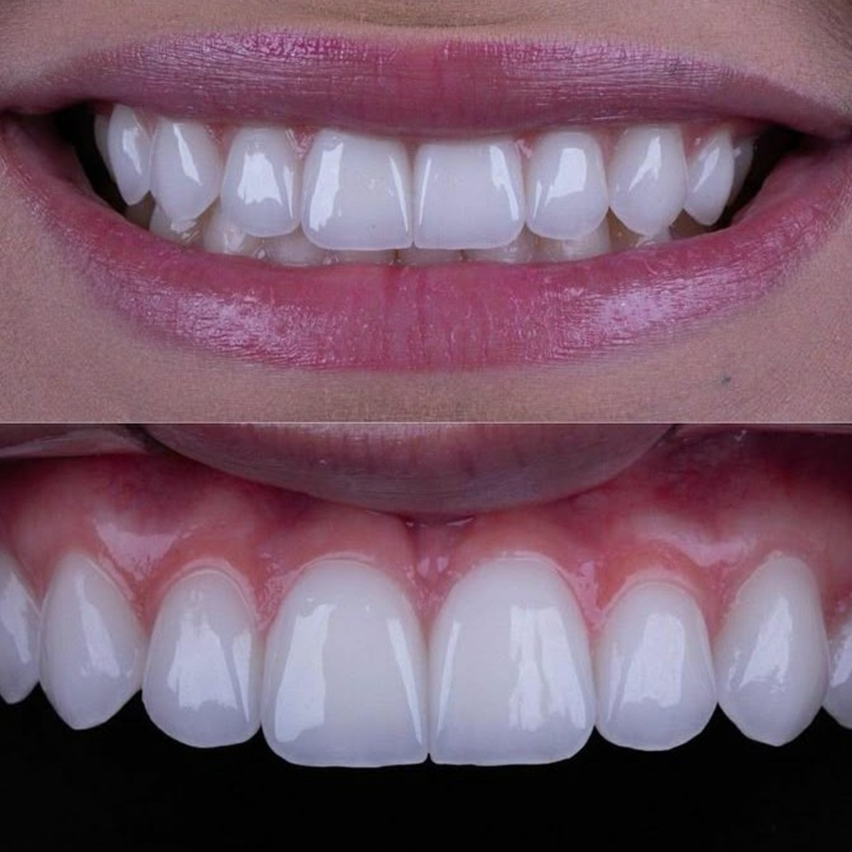 Ưu điểm của răng sứ Ceramill (Đức)