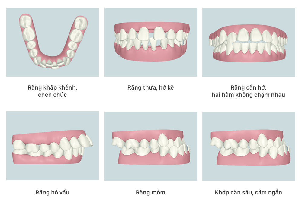 Các trường hợp cần niềng răng