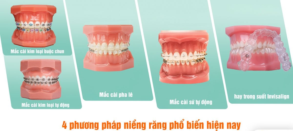 Các phương pháp niềng răng