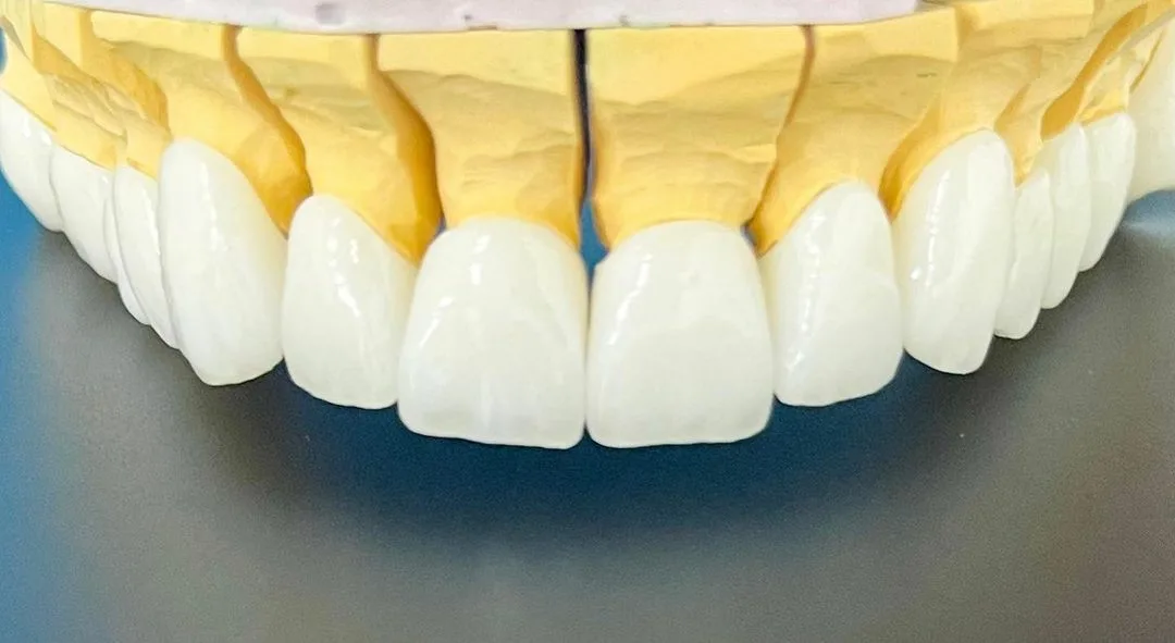  răng sứ Ceramill (Đức)