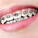 Niềng răng mắc cài kim loại 