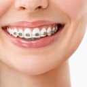 Niềng răng mắc cài kim loại tự buộc 