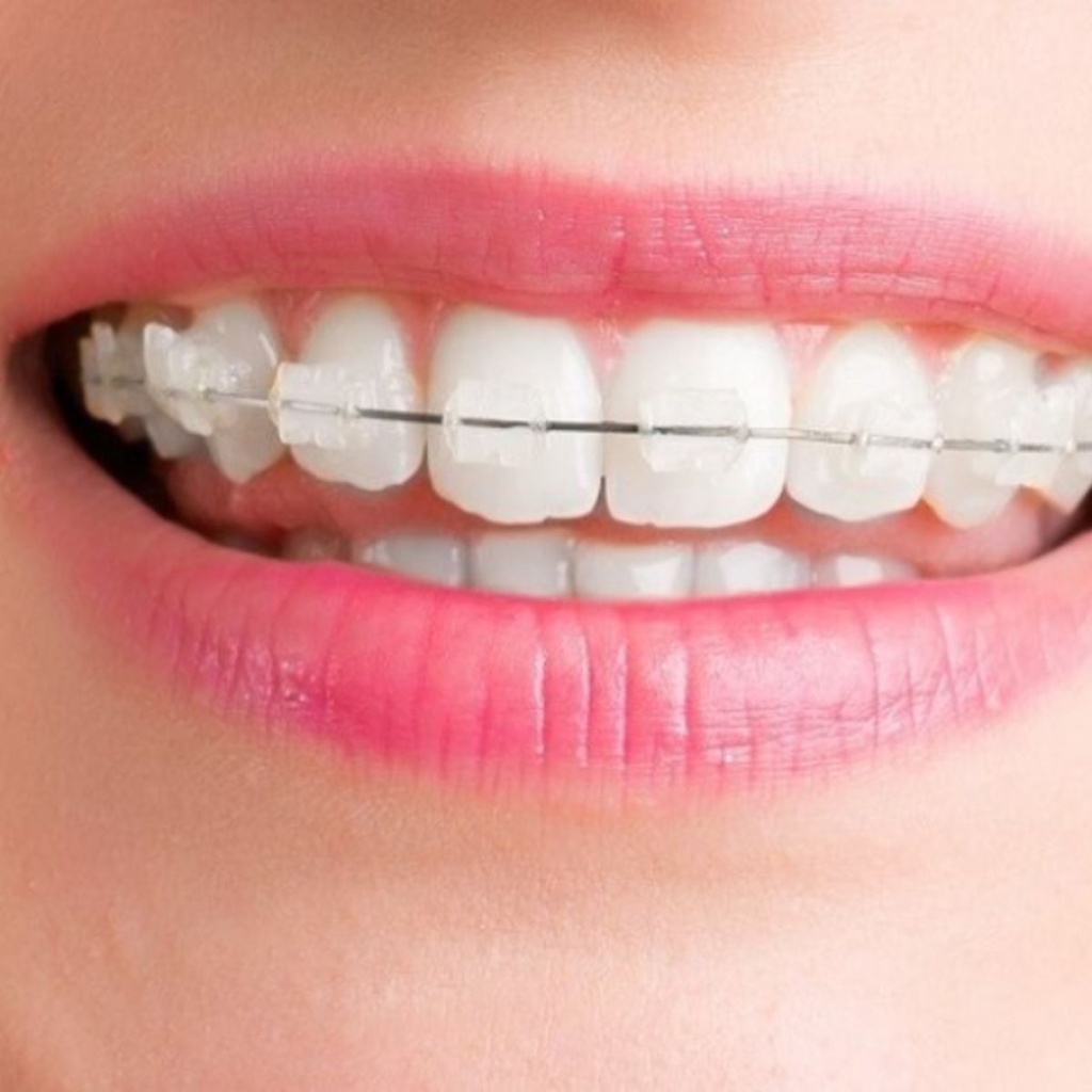 Niềng răng mắc cài sứ 