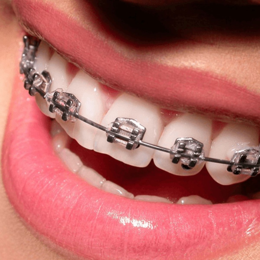 Chỉnh nha định hướng 1 hàm trọn gói 